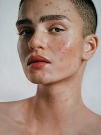 a woman with the phenomenal called skin purging, which occurs while introducing a new skincare product to your routine
